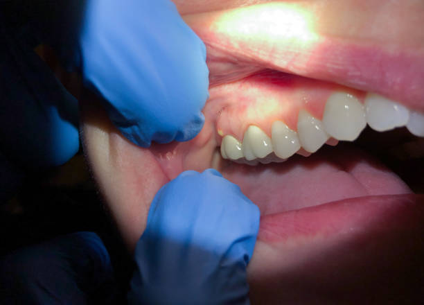 Best Emergency Dentist for Lost Fillings or Crowns in Uhrichsville, OH